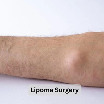 Liposuction Surgery