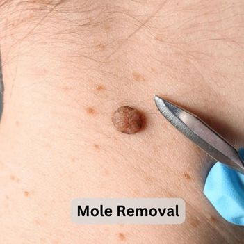 Mole Removal