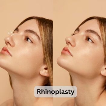 Rhinoplasty