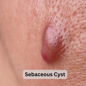 Sebaceous Cyst