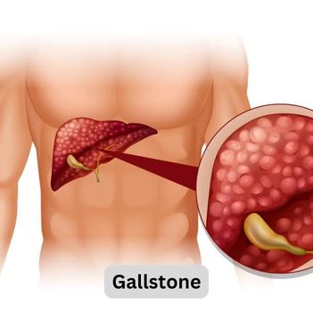 Gallstone