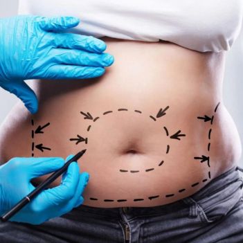 Liposuction Surgery