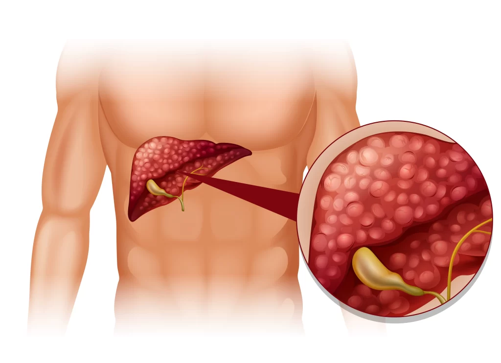 gallstone